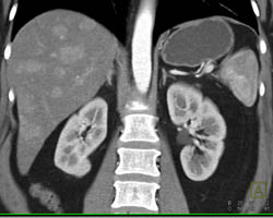 Metastatic Islet Cell Tumor - CTisus CT Scan