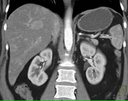 Metastatic Islet Cell Tumor - CTisus CT Scan