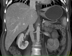 Metastatic Islet Cell Tumor - CTisus CT Scan