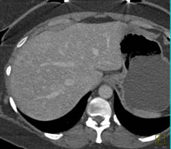 Metastatic Islet Cell Tumor - CTisus CT Scan