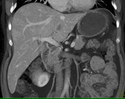 Metastatic Islet Cell Tumor - CTisus CT Scan