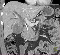 Tumor of Bile Duct With Spread - CTisus CT Scan