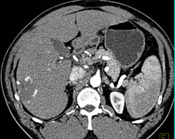 Hemangioma - CTisus CT Scan