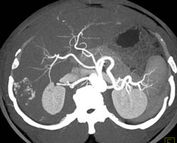 Hemangioma - CTisus CT Scan