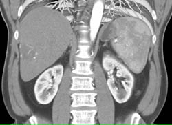 Hemangioma - CTisus CT Scan