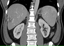 Hemangioma - CTisus CT Scan