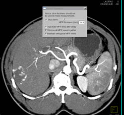 Hemangioma - CTisus CT Scan