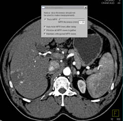 Hemangioma - CTisus CT Scan