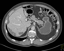 Subcapsular Fluid - CTisus CT Scan