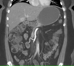 Liver Metastases - CTisus CT Scan