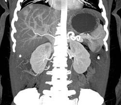 Vascular Liver Metastases Which Became Isodense With Neuroendocrine Tumor - CTisus CT Scan