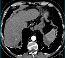 Hepatic Hemangioma in Various Phases - CTisus CT Scan