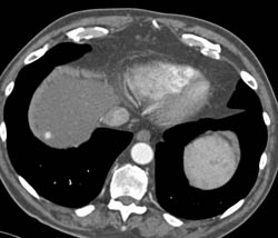 Small Hemangioma - CTisus CT Scan