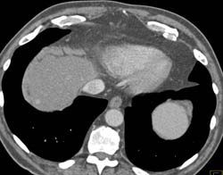 Focal Nodular Hyperplasia (FNH) - CTisus CT Scan