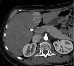 Focal Nodular Hyperplasia (FNH) - CTisus CT Scan