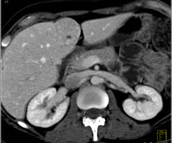 Focal Nodular Hyperplasia (FNH) - CTisus CT Scan