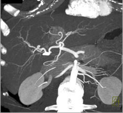 Focal Nodular Hyperplasia (FNH) - CTisus CT Scan