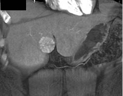 Focal Nodular Hyperplasia (FNH) - CTisus CT Scan