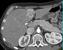 Focal Nodular Hyperplasia (FNH) - CTisus CT Scan