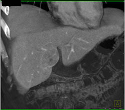 Focal Nodular Hyperplasia (FNH) - CTisus CT Scan