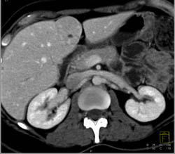 Focal Nodular Hyperplasia (FNH) - CTisus CT Scan