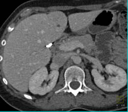 Focal Nodular Hyperplasia (FNH) - CTisus CT Scan