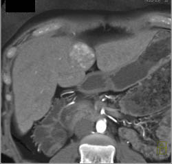 Focal Nodular Hyperplasia (FNH) - CTisus CT Scan