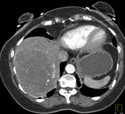 Hepatoma Which at First Look Can Be Confused With A Giant Hemangioma- Look at Full Sequence - CTisus CT Scan