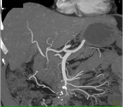 Carcinoid Mesentery With Liver Metastases - CTisus CT Scan