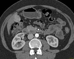 Focal Nodular Hyperplasia (FNH) - CTisus CT Scan