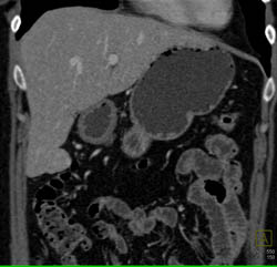 Focal Nodular Hyperplasia (FNH) - CTisus CT Scan