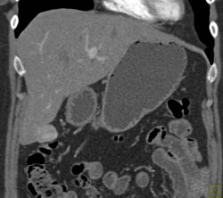 Focal Nodular Hyperplasia (FNH) - CTisus CT Scan