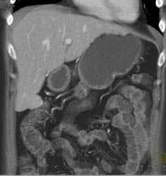 Focal Nodular Hyperplasia (FNH) - CTisus CT Scan