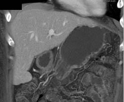 Focal Nodular Hyperplasia (FNH) - CTisus CT Scan