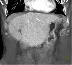 Cirrhosis With Nodular Pattern - CTisus CT Scan