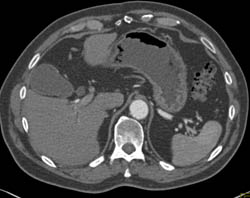 Stone in Common Bile Duct (CBD) - Easy to Miss. It Obstructs CBD - CTisus CT Scan