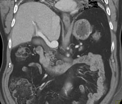 Portal Vein Aneurysm- Incidental Finding - CTisus CT Scan