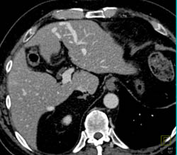 Arteriovenous Malformation (AVM) in Liver- Incidental Finding - CTisus CT Scan