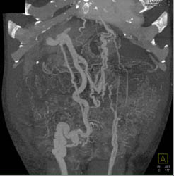 Huge Collaterals Due to Portal Hypertension - CTisus CT Scan