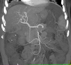 Hepatoma - CTisus CT Scan