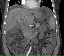 Hepatoma - CTisus CT Scan