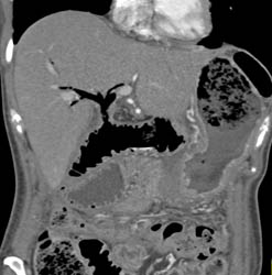 Anastomosis of Biliary Tree to Small Bowel - CTisus CT Scan