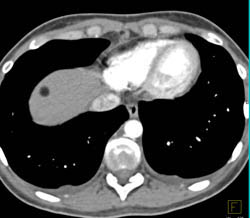 Lipoma - CTisus CT Scan