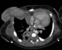 Herniation of Liver Through Chest Wall in Newborn - CTisus CT Scan