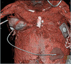 Liver Herniates Through A Defect in Chest Wall - CTisus CT Scan