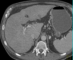 Portal Vein Thrombosis - CTisus CT Scan