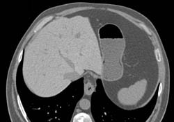 Hemochromatosis With Dense Liver - CTisus CT Scan