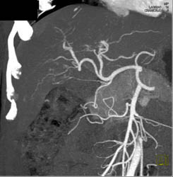 CTA in Cirrhosis - CTisus CT Scan