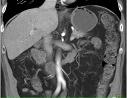 Flow Related Changes in Liver Centrally - CTisus CT Scan