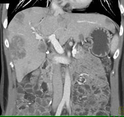 Metastatic Mucinous Tumor to the Liver - CTisus CT Scan